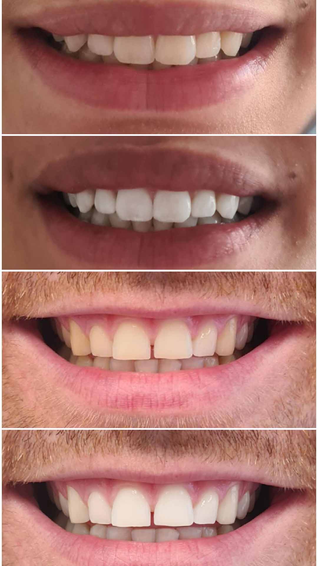 Laser Teeth Whitening Halo Glow Aesthetics